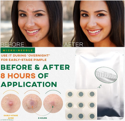 Microneedle Acne Healing Patches (9 Pack)