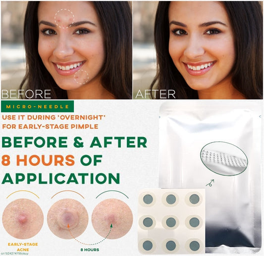 Microneedle Acne Healing Patches (9 Pack)