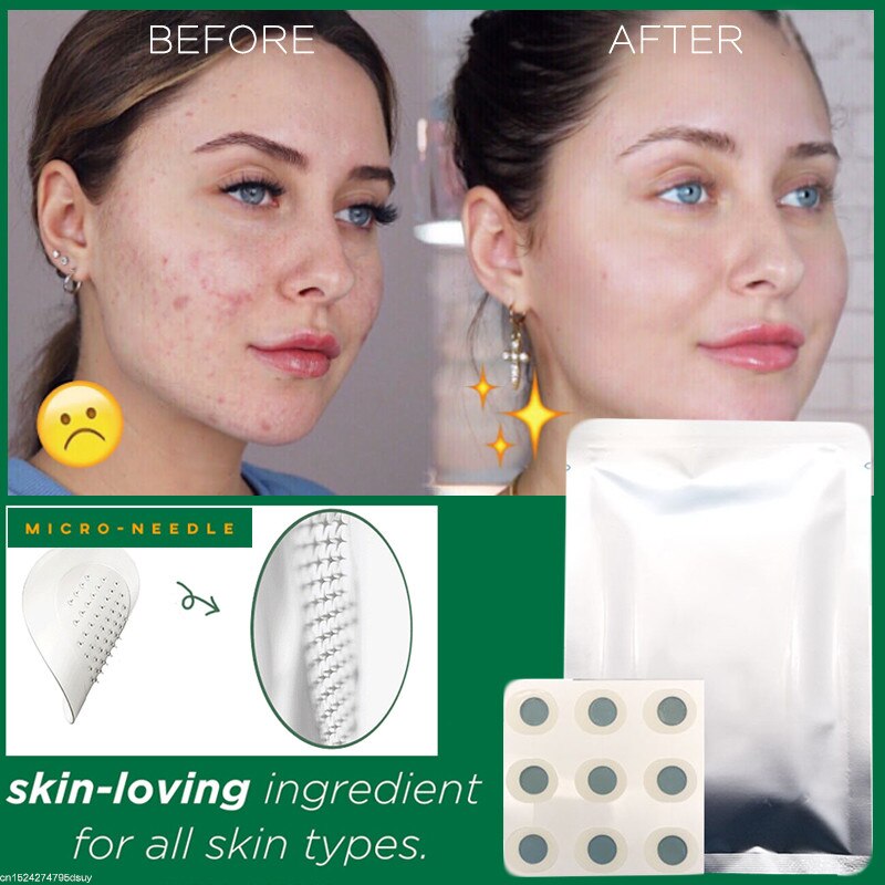 Microneedle Acne Healing Patches (9 Pack)